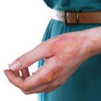 Burns caused by malfunctioning hair styling equipment