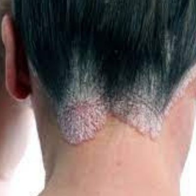 Skin blemishes and rashes caused by contaminated cosmetic products such as hair dyes